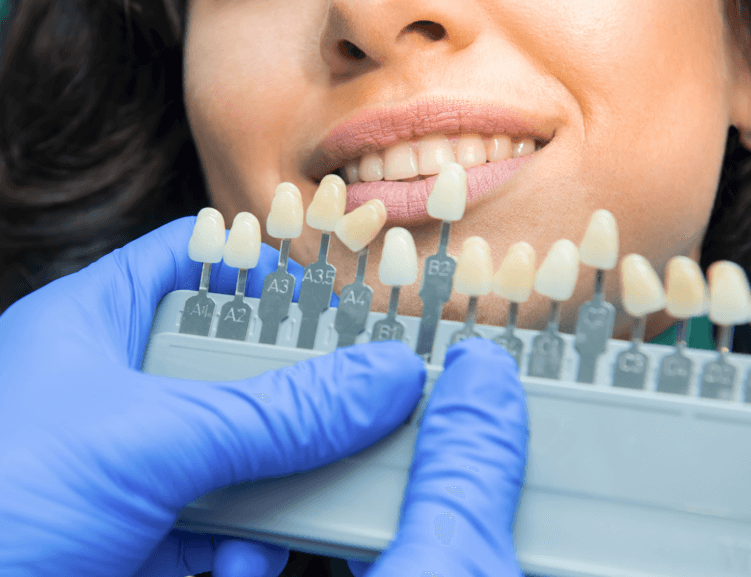 Uşak’ta Güvenli Diş Beyazlatmanın Faydaları