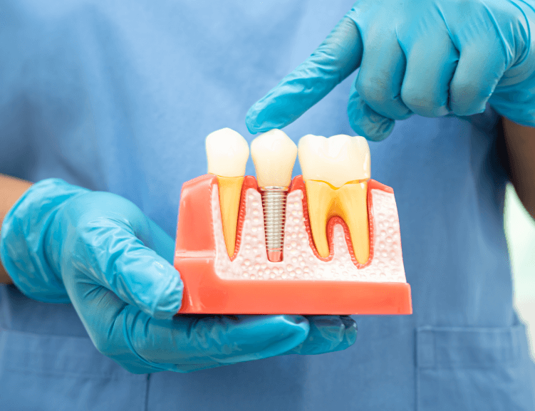 Diş Eti Hastalıklarının Tedavisinin Faydaları