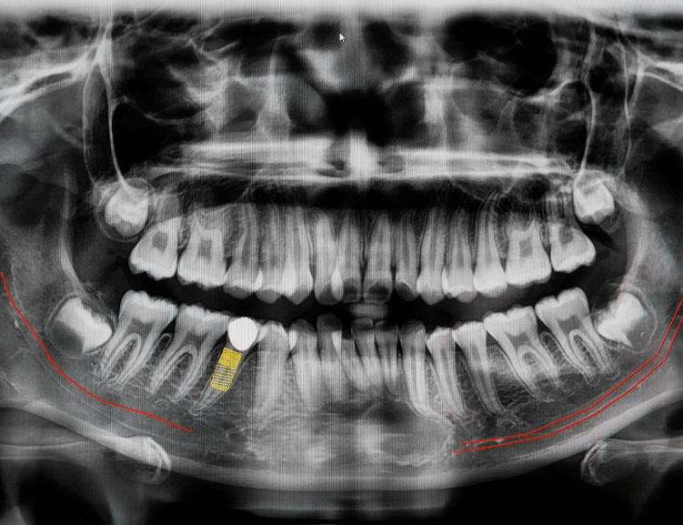 Gelişmiş Çene Ameliyatı Teknikleri