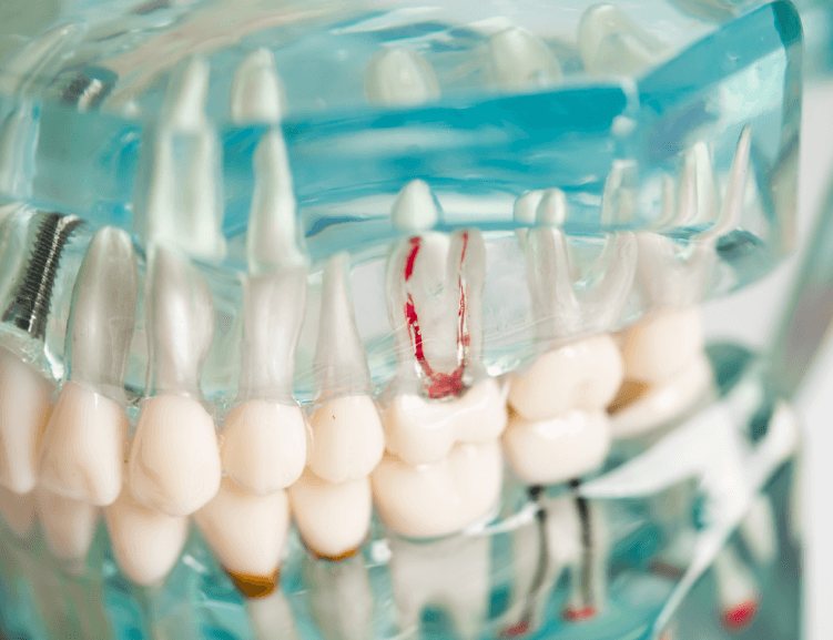 Gelişmiş Kanal Tedavisi Teknikleri